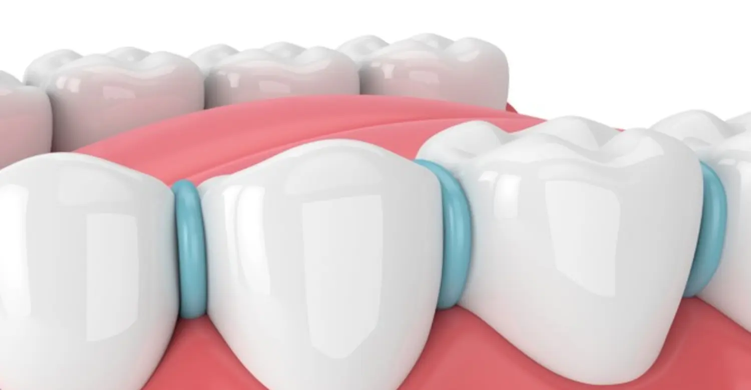 What are spacers orthodontics